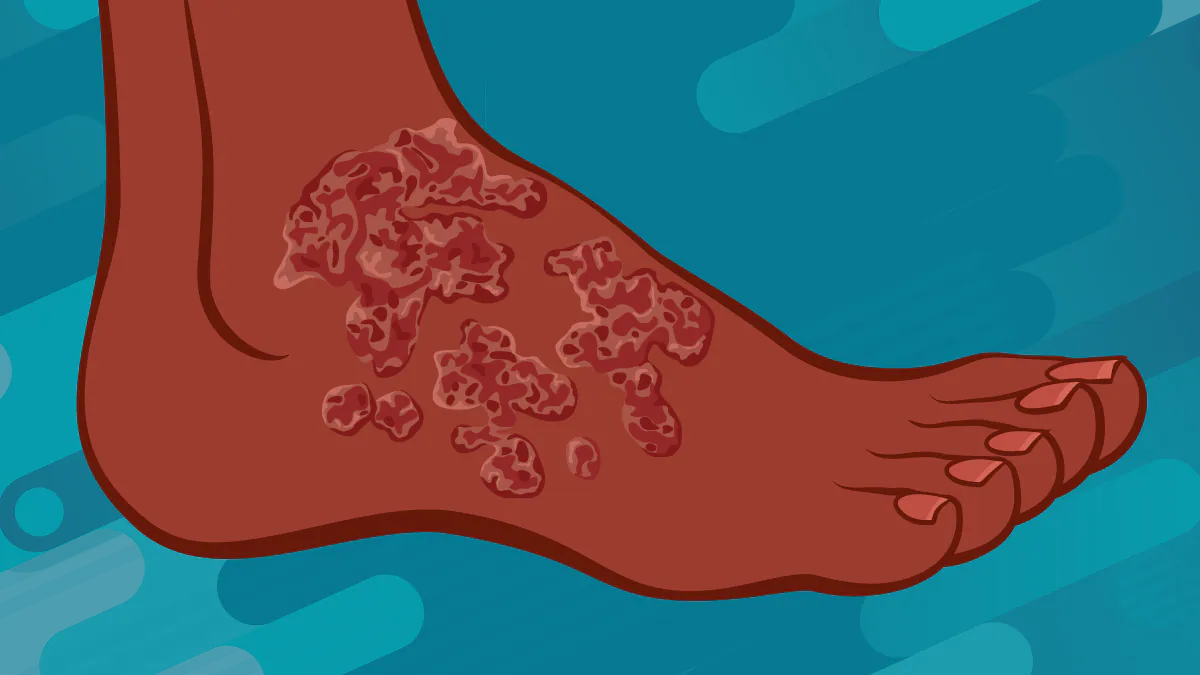 An illustration of a foot showing chromoblastomycosis