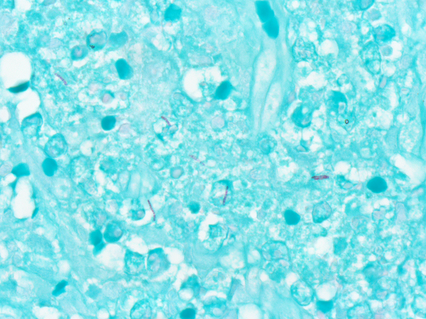 Acid-fast stain showing mycobacteria in a patient with Mycobacterium marinum skin infection