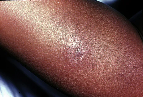 Close up image of a small, light, circular rash on dark skin.