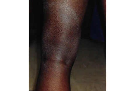 Image of a black person's back of knee showing a light colored circular rash taking up the majority of the back of the calf.