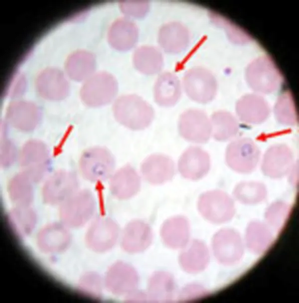 Blood smear showing plasmodium falciparum parasites