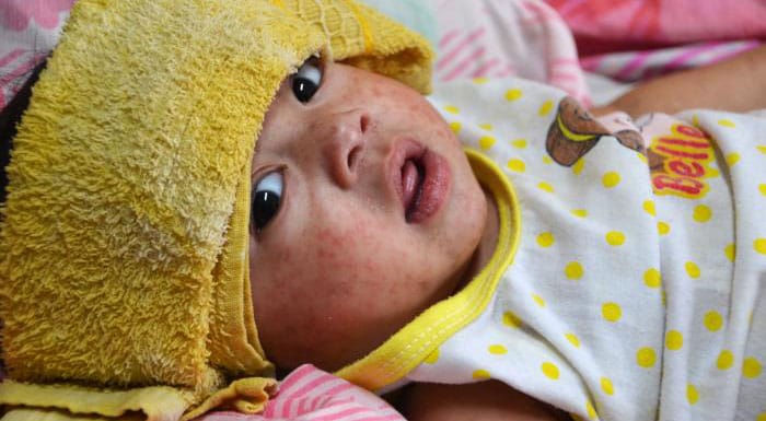 Photographed early in 2014 in the Philippines capital city of Manila, this baby was in a hospital with measles (rubeola). Since typhoon Haiyan, the Philippines, especially metropolitan Manila, has been experiencing a large measles outbreak.