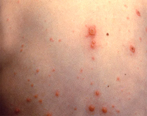 Chickenpox Chickenpox on back