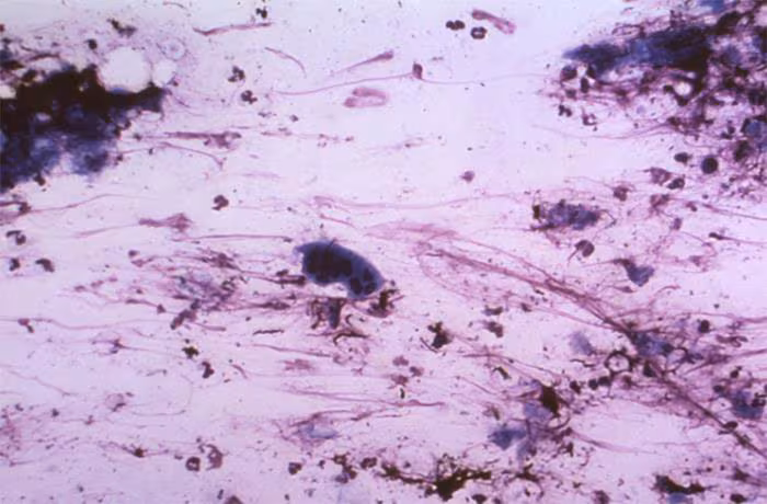 Varicella-zoster virus Varicella-zoster virus under microscope