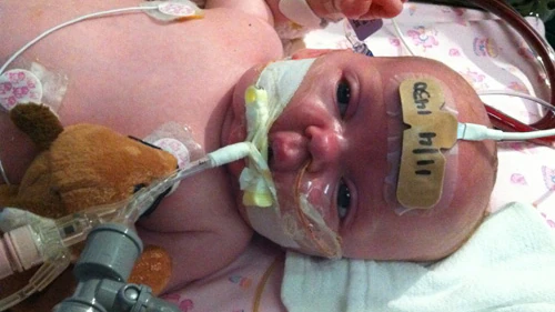 An infant being treated for severe pertussis infection