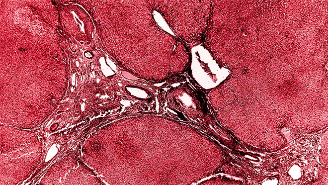 Schistosomiasis in liver tissue