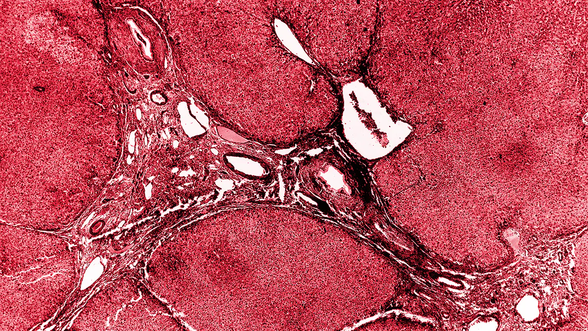 liver sample showing schistosomiasis infection