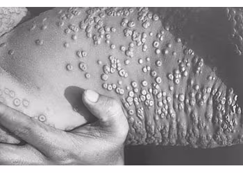 Smallpox Eruptive Stage A torso covered in smallpox lesions