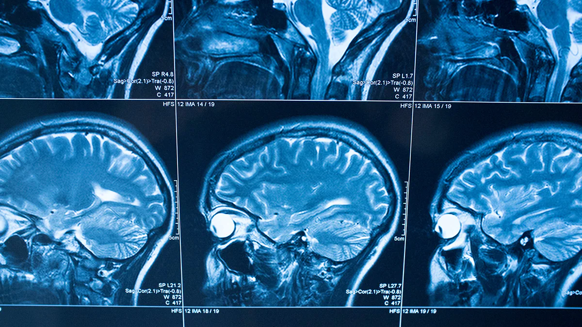 MRI images of a person's head and brain