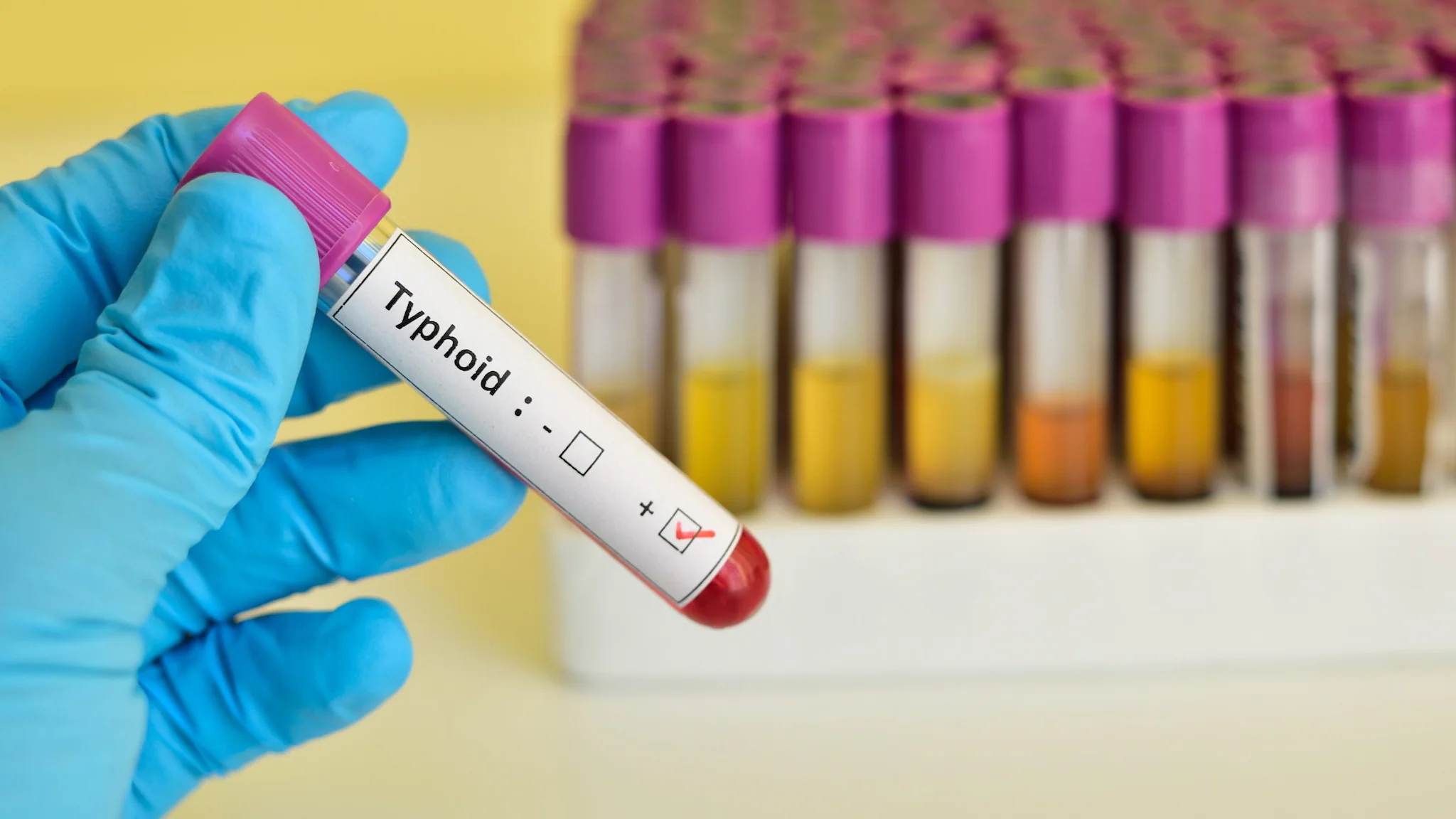 A blue gloved hand holding a positive Typhoid blood sample. A plastic tray holding other samples sits in the background.