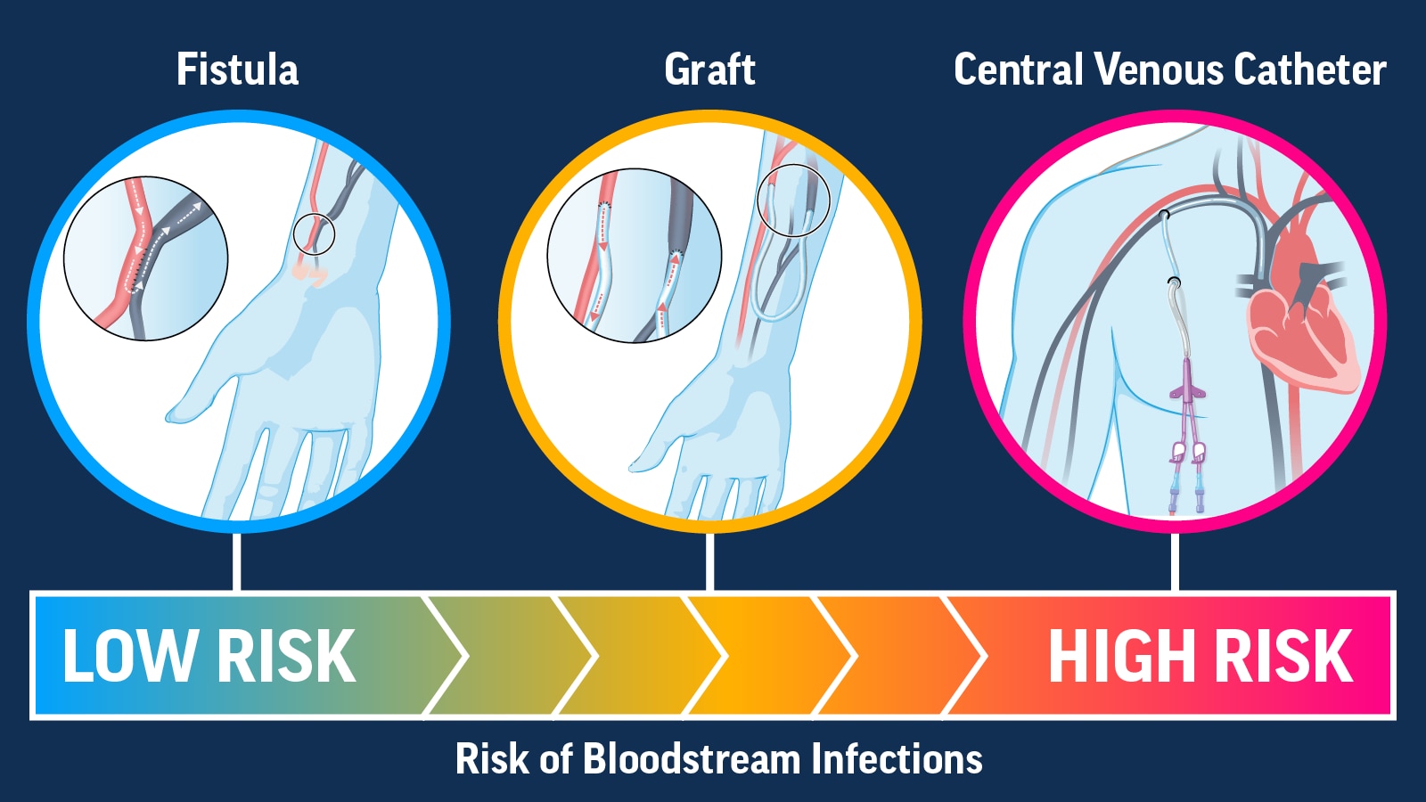 Infographic 3: Increase Use of Lower-Risk Vascular Access Types for Dialysis